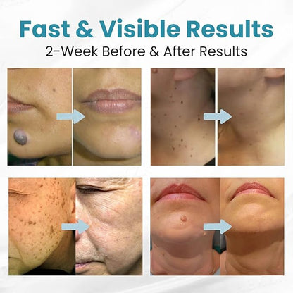 Non Invasive Mole and Wart Removal Pen