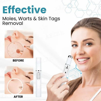 Non Invasive Mole and Wart Removal Pen